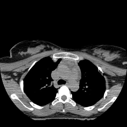File:Choriocarcinoma of ovary with cerebral and pulmonary metastases (Radiopaedia 25983-26119 Axial non-contrast 112).jpg