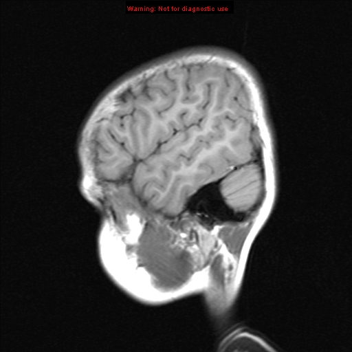 File:Choroid plexus papilloma (Radiopaedia 8466-9290 Sagittal T1 18).jpg