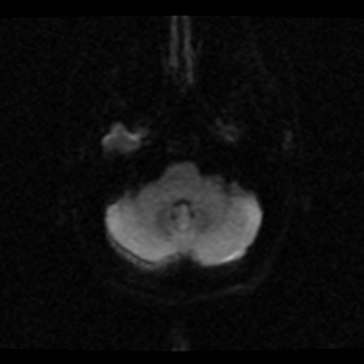File:Choroid plexus xanthogranuloma (Radiopaedia 17650-17386 DWI 19).jpg