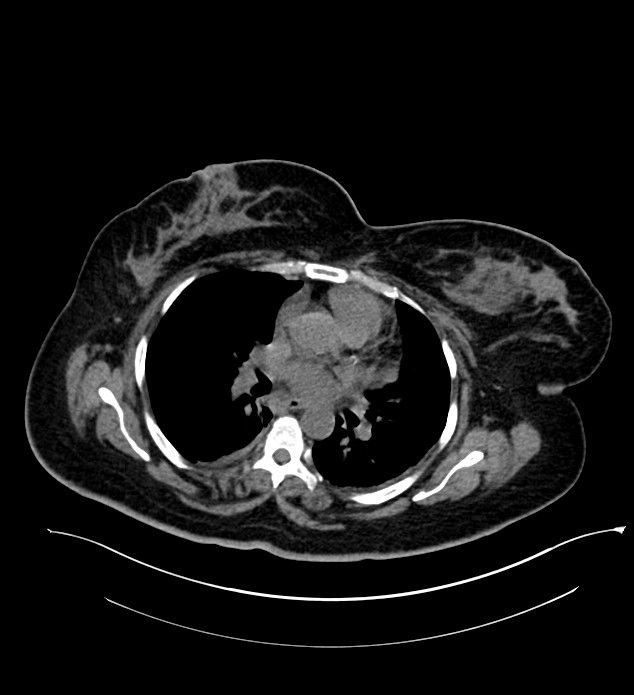 Chromophobe renal cell carcinoma (Radiopaedia 84239-99519 Axial non-contrast 4).jpg