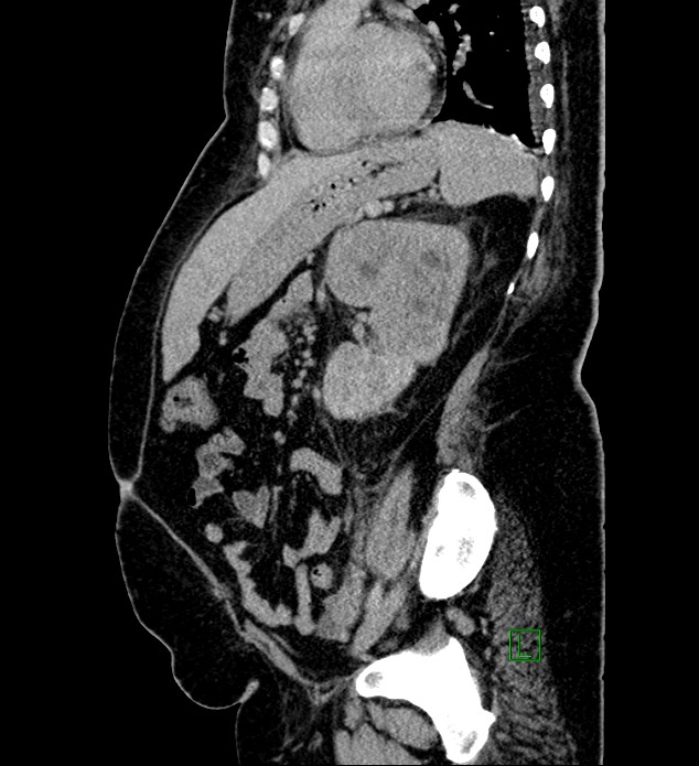Chromophobe renal cell carcinoma (Radiopaedia 84239-99519 G 43).jpg