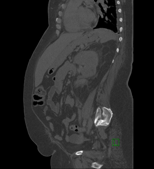 Chromophobe renal cell carcinoma (Radiopaedia 84239-99519 Sagittal bone window 40).jpg
