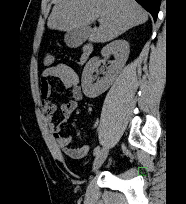Chromophobe renal cell carcinoma (Radiopaedia 84286-99573 C 122).jpg