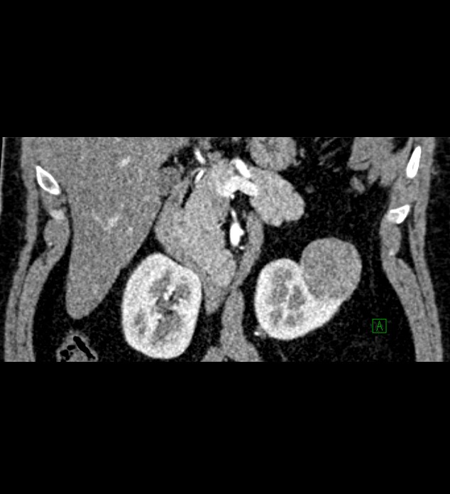 Chromophobe renal cell carcinoma (Radiopaedia 84286-99573 E 24).jpg