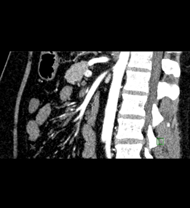 Chromophobe renal cell carcinoma (Radiopaedia 84286-99573 F 80).jpg