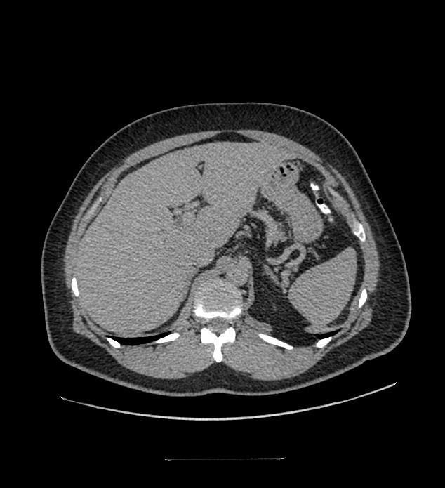 Chromophobe renal cell carcinoma (Radiopaedia 84337-99644 Axial C+ delayed 36).jpg