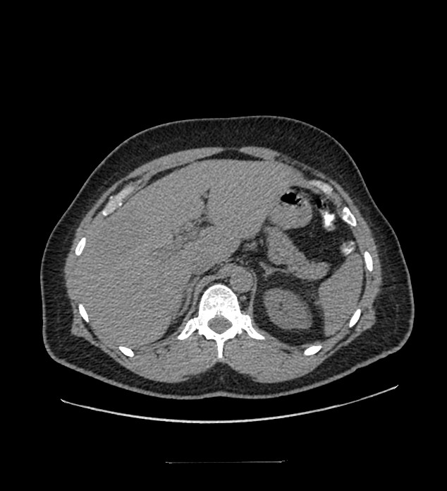 Chromophobe renal cell carcinoma (Radiopaedia 84337-99644 Axial non-contrast 24).jpg