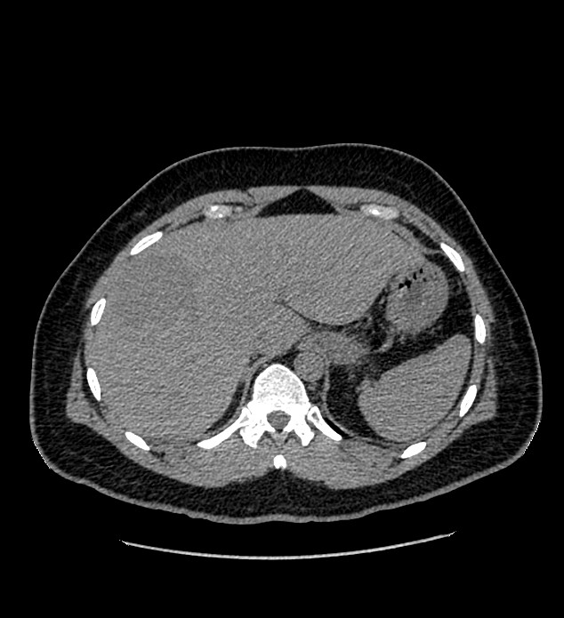 Chromophobe renal cell carcinoma (Radiopaedia 84337-99693 Axial non-contrast 18).jpg