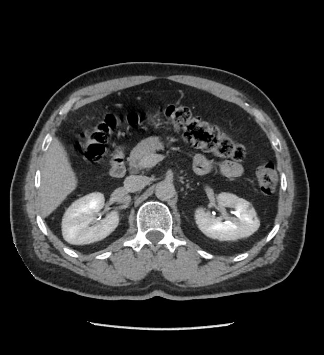Chromophobe renal cell carcinoma (Radiopaedia 86879-103083 D 50).jpg