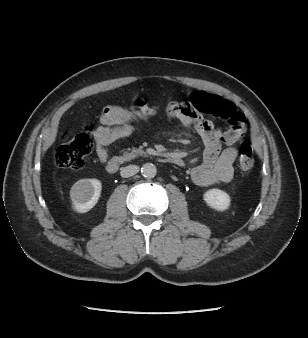 Chromophobe renal cell carcinoma (Radiopaedia 86879-103083 D 68).jpg