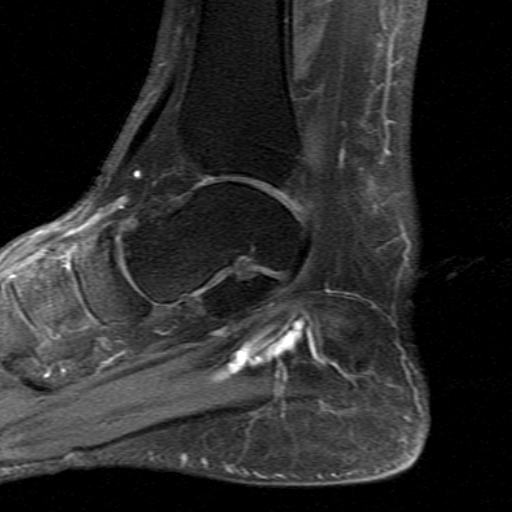 File:Chronic Achilles tendon rupture (Radiopaedia 15262-15100 C 10).jpg