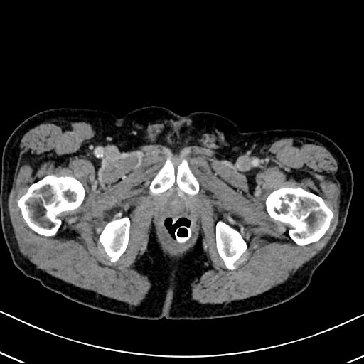 Chronic appendicitis complicated by appendicular abscess, pylephlebitis and liver abscess (Radiopaedia 54483-60700 B 150).jpg