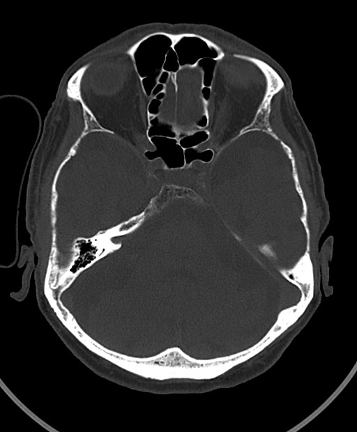Chronic bilateral subdural hygroma (Radiopaedia 85801-101623 Axial bone window 87).jpg