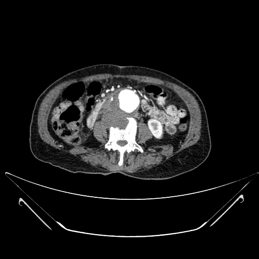 File:Chronic contained rupture of abdominal aortic aneurysm with extensive erosion of the vertebral bodies (Radiopaedia 55450-61901 A 34).jpg
