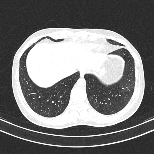 File:Chronic eosinophilic pneumonia (Radiopaedia 39331-41587 Axial lung window 46).png