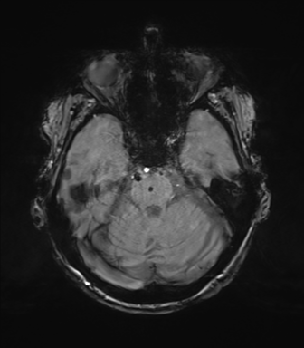Chronic hypertensive encephalopathy (Radiopaedia 72844-83495 Axial SWI magnitude 25).png