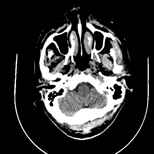 Chronic invasive fungal sinusitis (Radiopaedia 91563-109286 Axial non-contrast 4).jpg