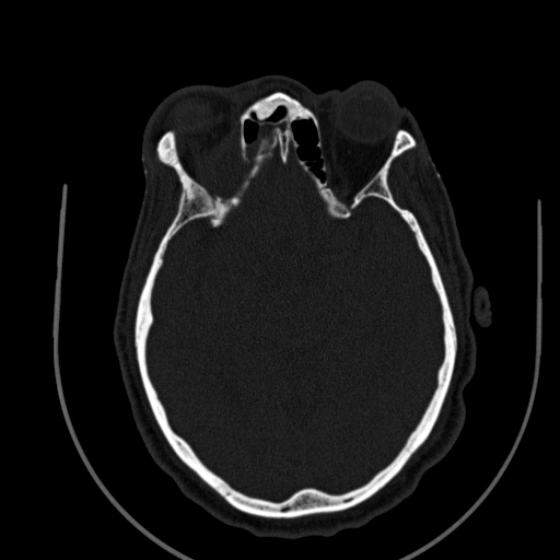 Chronic invasive fungal sinusitis (Radiopaedia 91563-109286 Axial sinus 105).jpg
