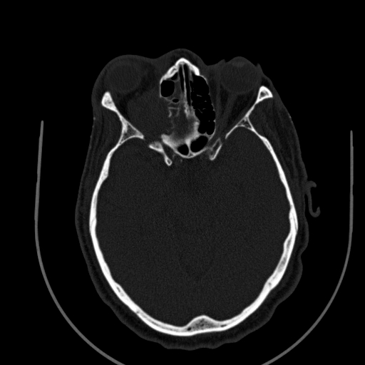 File:Chronic invasive fungal sinusitis (Radiopaedia 91563-109286 Axial sinus 96).jpg