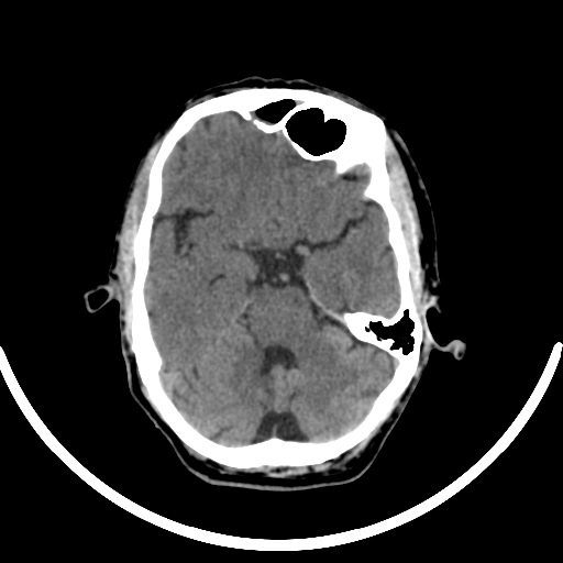 File:Chronic invasive fungal sinusitis with intraorbital and intracranial extension (Radiopaedia 56387-63046 Axial non-contrast 155).jpg