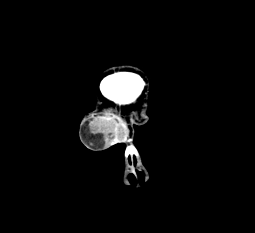 Chronic invasive fungal sinusitis with intraorbital and intracranial extension (Radiopaedia 56387-63046 C 27).jpg