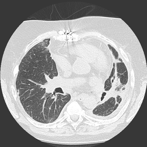 Chronic lung allograft dysfunction - restrictive form (Radiopaedia 60595-68316 Axial lung window 34).jpg