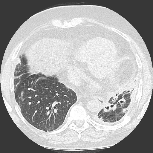 File:Chronic lung allograft dysfunction - restrictive form (Radiopaedia 60595-68316 Axial lung window 50).jpg