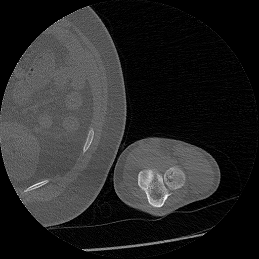 Chronic osteomyelitis (Radiopaedia 67597-76998 Axial bone window 75).jpg