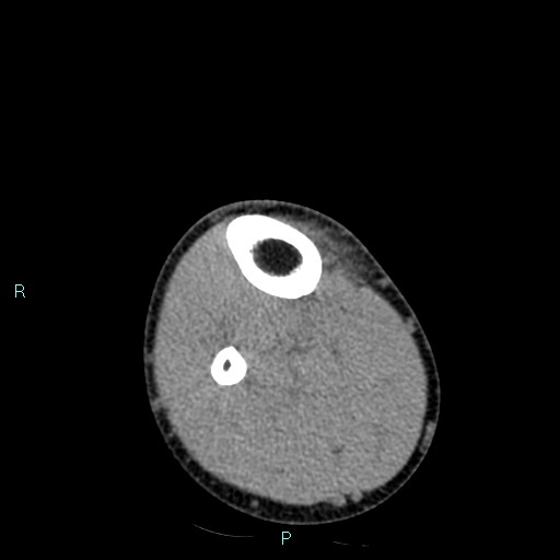 Chronic osteomyelitis (with Brodie abscess) (Radiopaedia 76405-88111 A 27).jpg