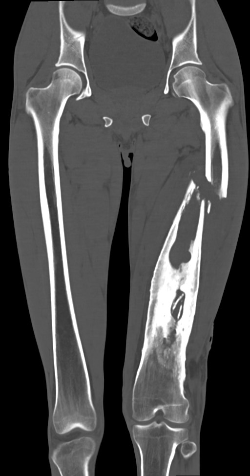 Chronic osteomyelitis (with sequestrum) (Radiopaedia 74813-85822 Coronal non-contrast 27).jpg