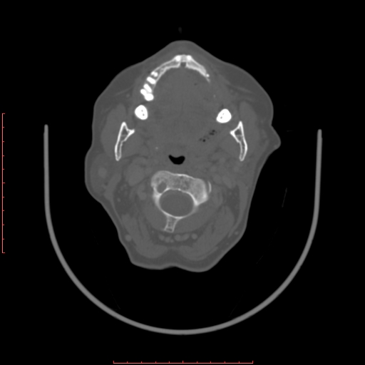 File:Chronic osteomyelitis - maxilla (Radiopaedia 23783-23927 Axial bone window 67).jpg