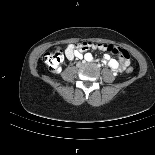 File:Chronic pancreatitis (Radiopaedia 64576-73450 B 106).jpg