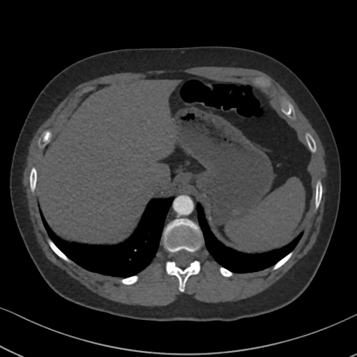 File:Chronic pulmonary embolus (Radiopaedia 39129-41341 Axial C+ CTPA 91).png