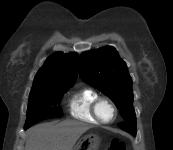 Chronic pulmonary embolus (Radiopaedia 39129-41341 Coronal C+ CTPA 22).png