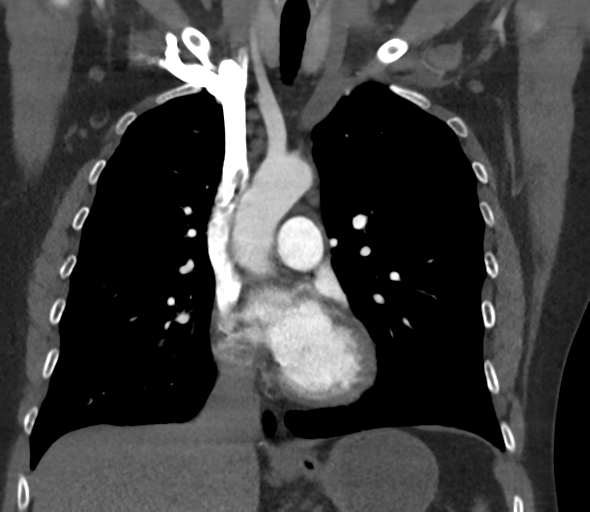 File:Chronic pulmonary embolus (Radiopaedia 39129-41341 Coronal C+ CTPA 40).png