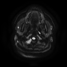 Chronic submandibular sialadenitis (Radiopaedia 61852-69885 Axial DWI 8).jpg
