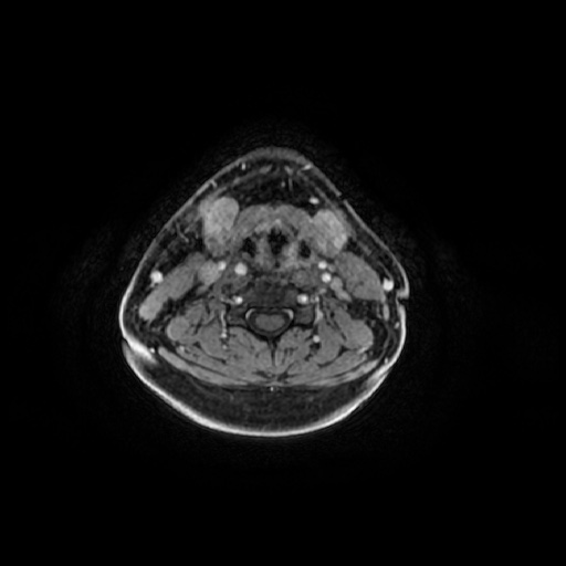 Chronic submandibular sialadenitis (Radiopaedia 61852-69885 Axial T1 C+ fat sat 35).jpg