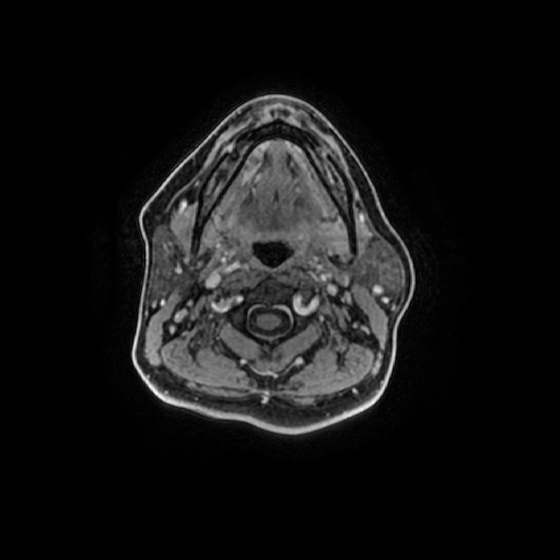 Chronic submandibular sialadenitis (Radiopaedia 61852-69885 Axial T1 C+ fat sat 65).jpg