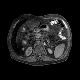 Cirrhosis and hepatocellular carcinoma in the setting of hemochromatosis (Radiopaedia 75394-86594 Axial T1 C+ fat sat 38).jpg
