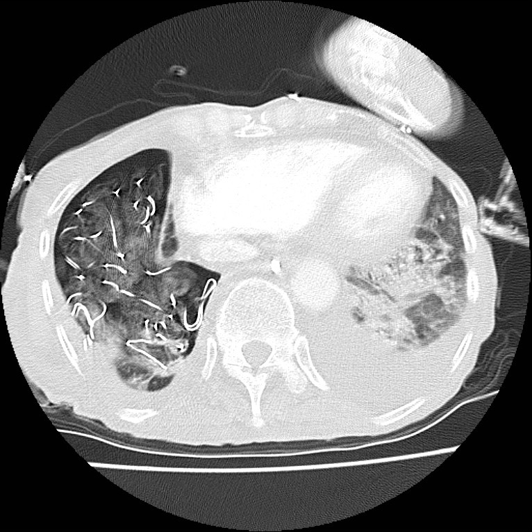 Clagett thoracotomy with bronchopleural fistula (Radiopaedia 29192-29587 Axial lung window 39).jpg