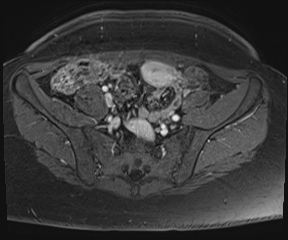 File:Class II Mullerian duct anomaly- unicornuate uterus with rudimentary horn and non-communicating cavity (Radiopaedia 39441-41755 Axial T1 fat sat 12).jpg