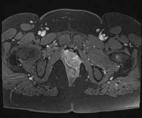 File:Class II Mullerian duct anomaly- unicornuate uterus with rudimentary horn and non-communicating cavity (Radiopaedia 39441-41755 Axial T1 fat sat 125).jpg