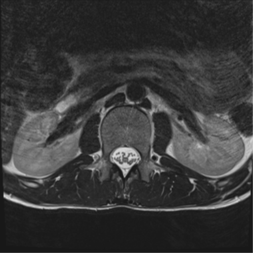 File:Clear cell meningoma - lumbar spine (Radiopaedia 60116-67690 Axial T2 38).png