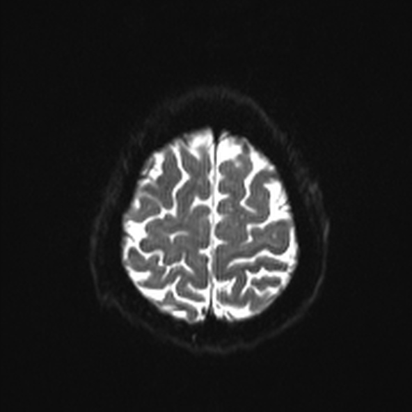 File:Clival meningioma (Radiopaedia 53278-59248 Axial DWI 22).jpg