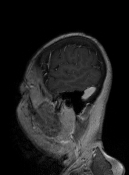 Clival meningioma (Radiopaedia 53278-59248 Sagittal T1 C+ 151).jpg