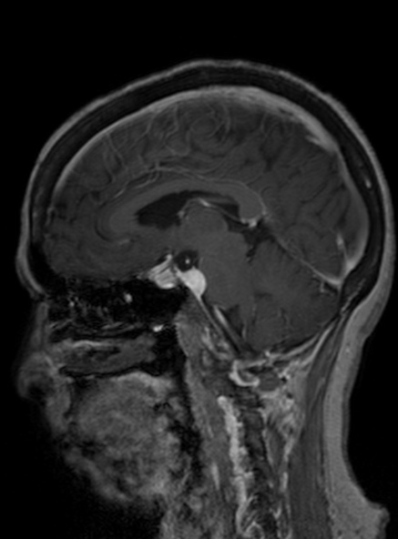 Clival meningioma (Radiopaedia 53278-59248 Sagittal T1 C+ 268).jpg