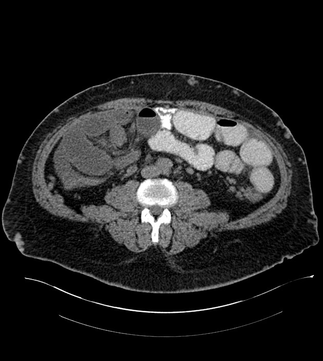 Closed-loop small bowel obstruction-internal hernia (Radiopaedia 78439-91096 Axial non-contrast 91).jpg