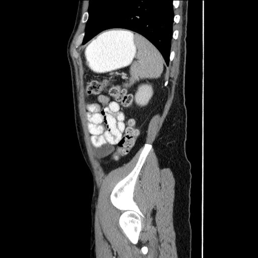 File:Closed-loop small bowel obstruction (Radiopaedia 73713-84509 B 134).jpg