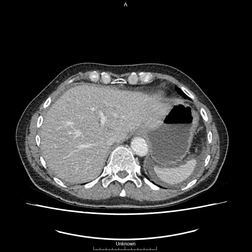 Closed loop bowel obstruction and ischemia (Radiopaedia 86959-103180 A 4).jpg