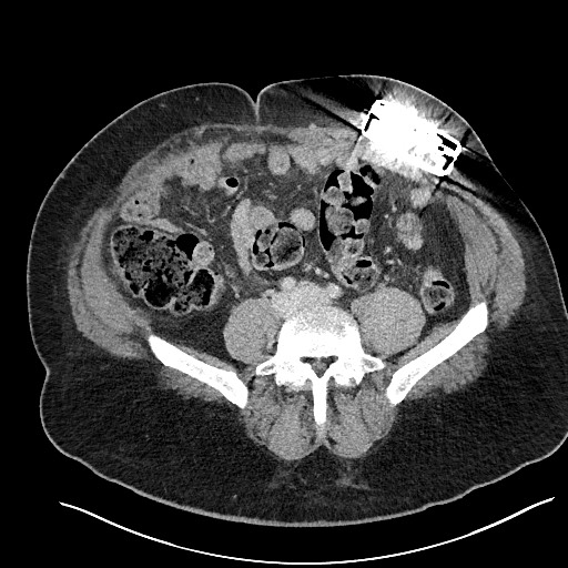 File:Closed loop obstruction - internal hernia into nephrectomy bed (Radiopaedia 59867-67320 A 93).jpg